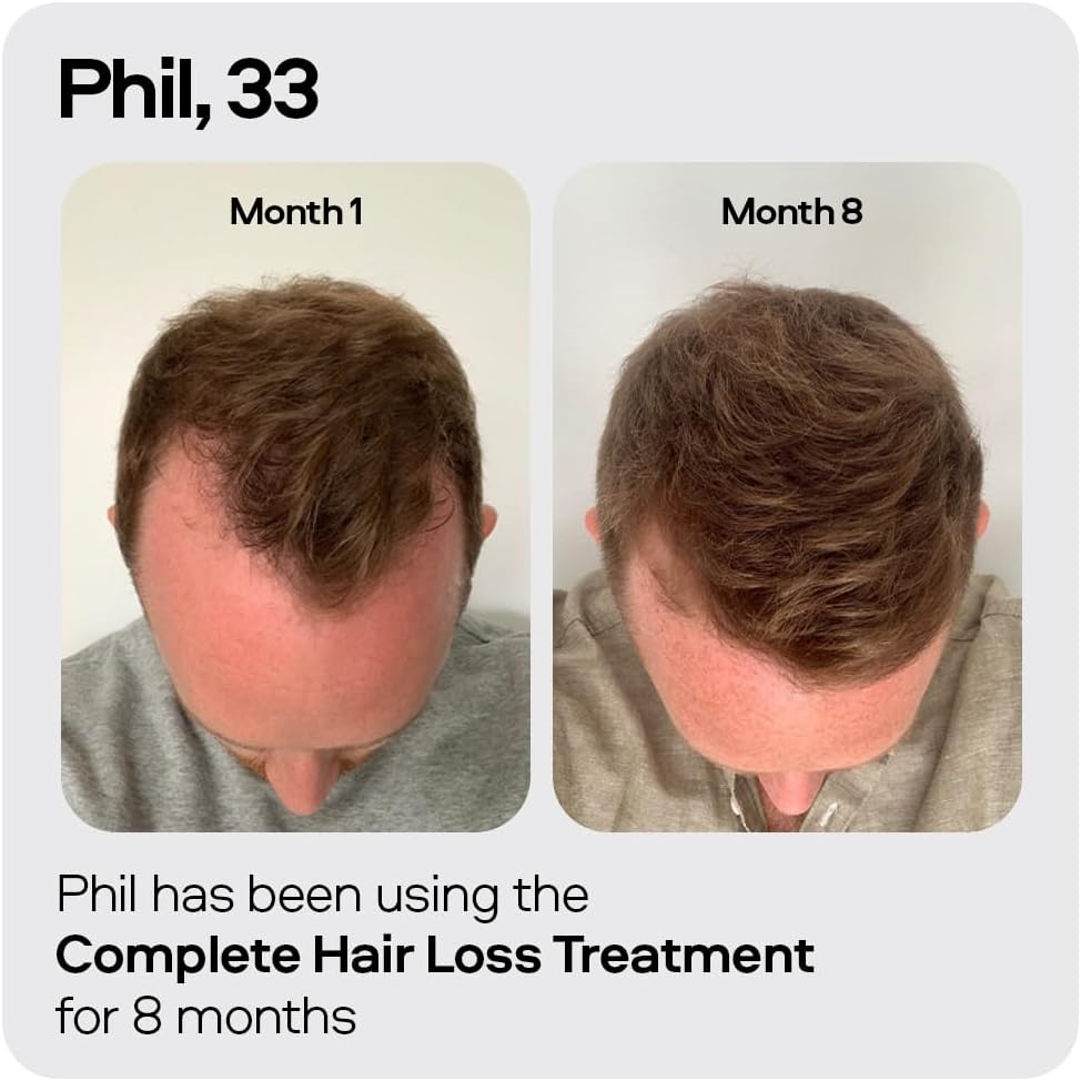 Sons Minoxidil 5% Cutaneous Solution, Hair Regrowth & Thickener Formula, For Hair Loss & Thinning in Men, Reactivates Shrunken Follicles, Precision Application System, 1 Month Supply Made in Europe