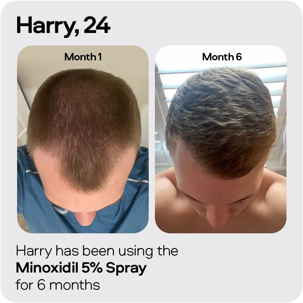 Sons Minoxidil 5% Cutaneous Solution, Hair Regrowth & Thickener Formula, For Hair Loss & Thinning in Men, Reactivates Shrunken Follicles, Precision Application System, 1 Month Supply Made in Europe