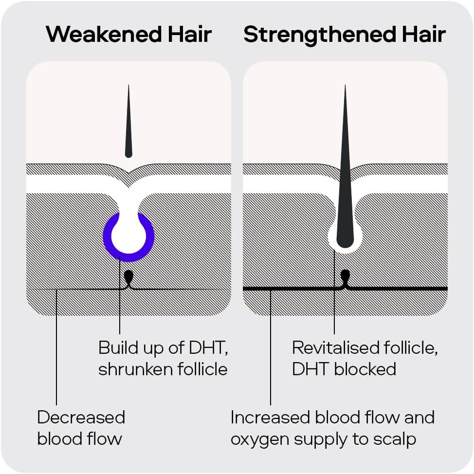 Sons Minoxidil 5% Cutaneous Solution, Hair Regrowth & Thickener Formula, For Hair Loss & Thinning in Men, Reactivates Shrunken Follicles, Precision Application System, 1 Month Supply Made in Europe